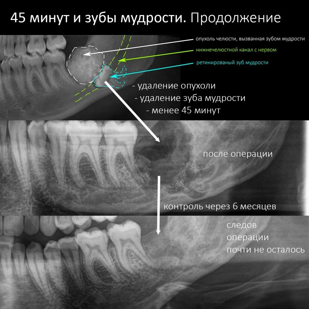Когда перестанет болеть после удаления зуба