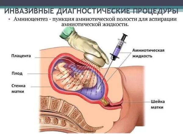 Трансабдоминальный кордоцентез. Трансабдоминальный кордоцентез. Плацентоцентез это. Плацентоцентез это. Биопсия хориона амниоцентез кордоцентез.
