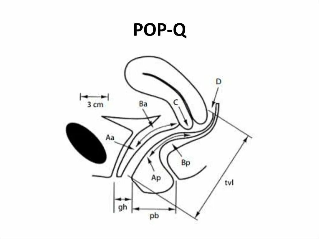Pop q классификация пролапса. Классификация Pop-q. Пролапс гениталий по Pop-q. Pop q пролапс. Опущение женских половых органов