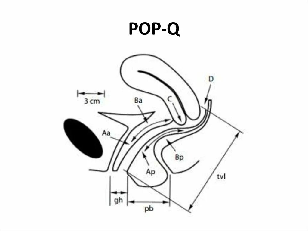 Опущение женских половых органов. Pop q классификация пролапса. Классификация Pop-q. Пролапс гениталий по Pop-q. Pop q пролапс.