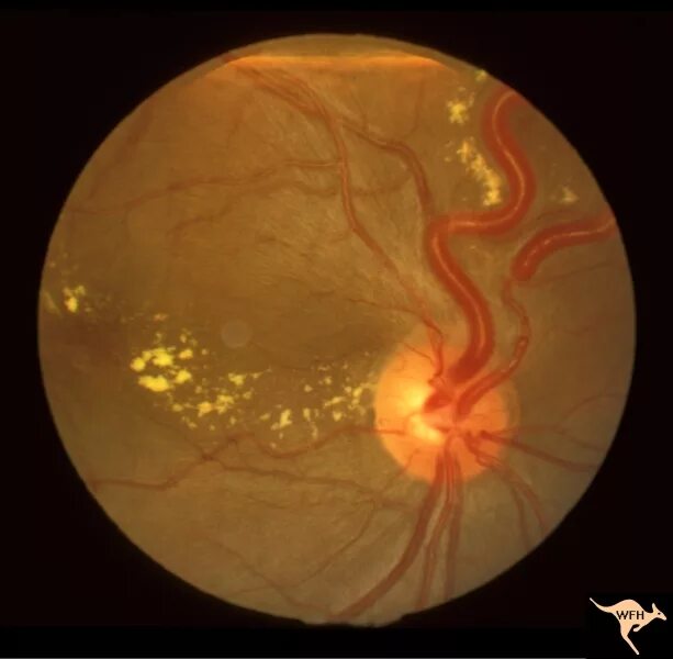 Ангиоматоз гиппеля линдау. Ретиноцеребеллярный ангиоматоз гиппеля–линдау. Синдром фон. Ангиоматоз гиппеля линдау. Телеангиэктазии при линдау.