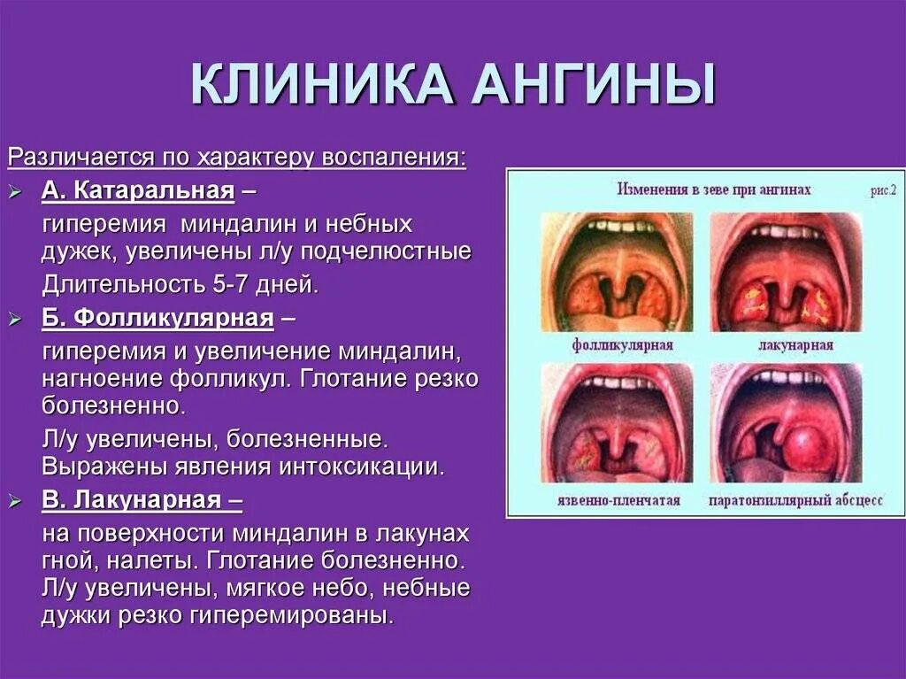 Фарингит - симптомы и лечение в СПб