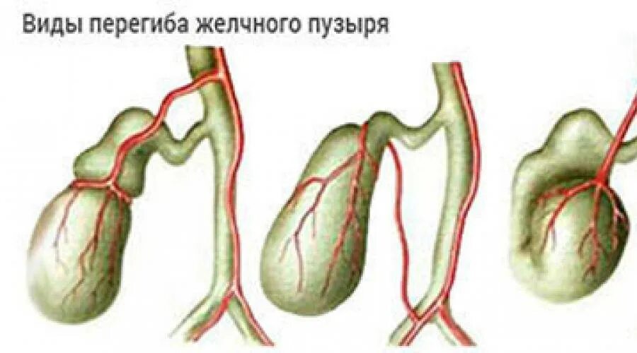 Загиб желчного пузыря. Аномалия желчного пузыря Перегиб. Заворот желчного пузыря. Загиб Перегиб желчного пузыря. Изгиб шейки желчного