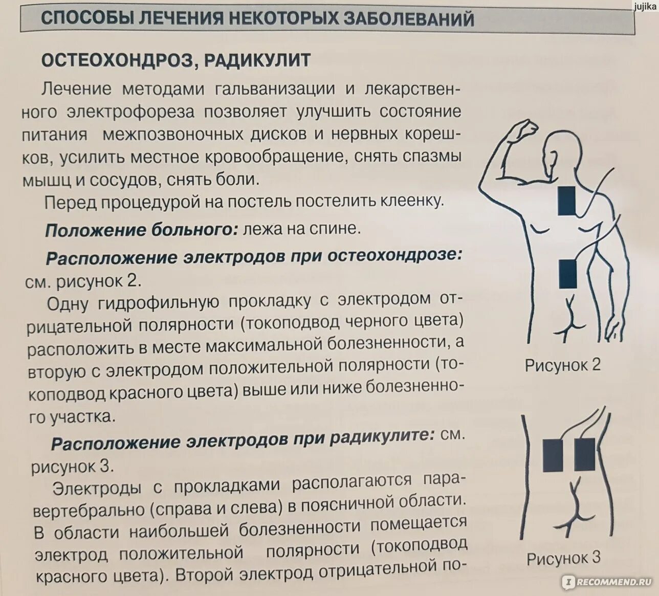 Электрофорез с эуфиллином на позвоночник. Гальванизация методом электрофореза. Электрофорез электроды схема. Расположение электродов при электрофорезе. Методика электрофореза при остеохондрозе.