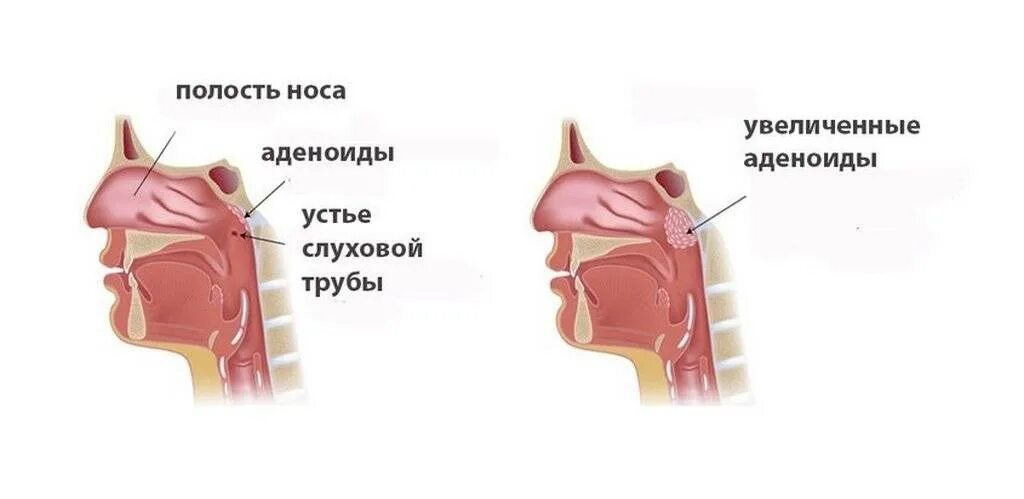 Аденоидный вегетация 3. Аденоиды 2-3 степени у ребенка. Аденоиды 3 степени у ребенка. Аденоиды 2 степени операция. Аденоиды в носу у детей 2 степени.