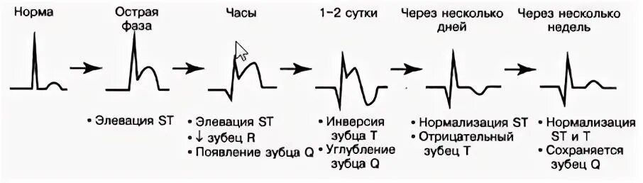 Типичные изменения экг при ботулизме. Типичные изменения экг при ботулизме