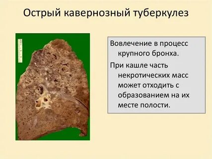 Кавернозный и фиброзно кавернозный туберкулез легких презентация
