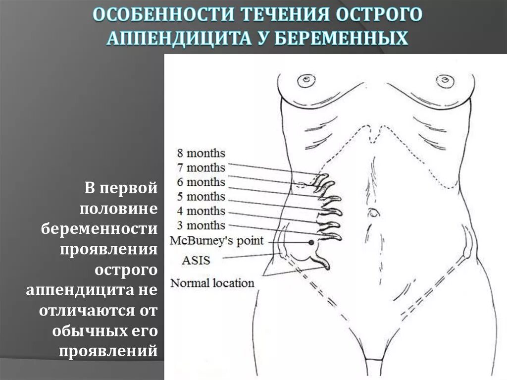 Где аппендицит с какой. Где аппендицит с какой