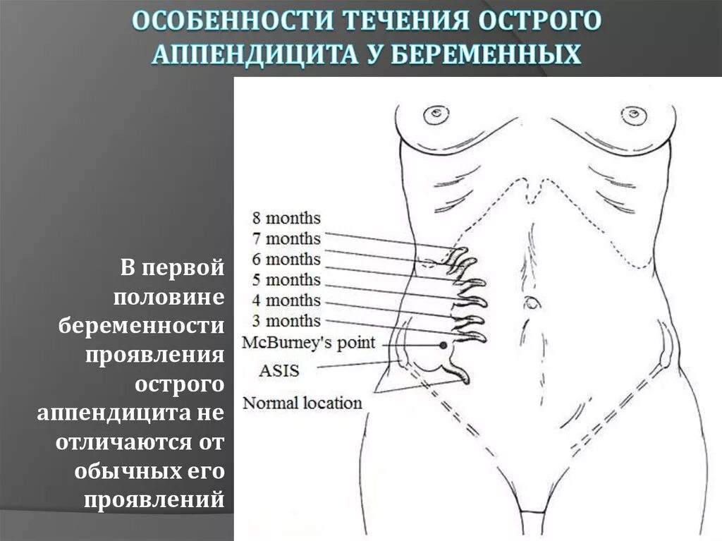 Локализация боли при остром аппендиците. Место расположения аппендикса. Место расположения аппендицита.