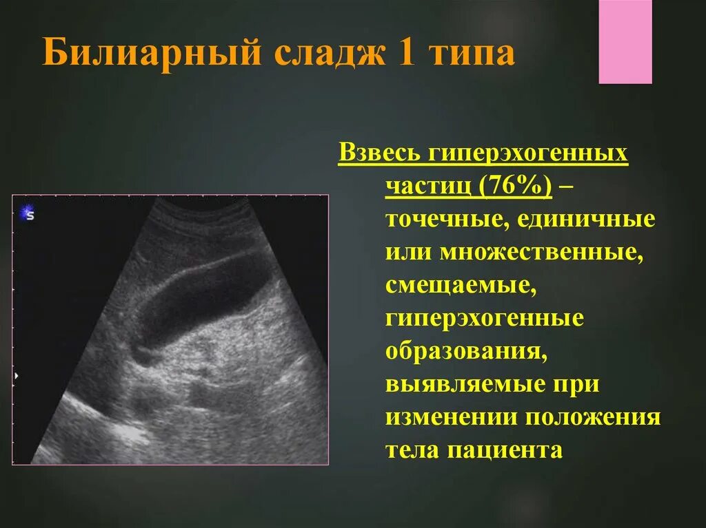 Билиарная гипертензия это. Билиарный сладж 1 типа. Билиарный сладж в желчном пузыре. Сладж-синдром желчного пузыря на УЗИ.