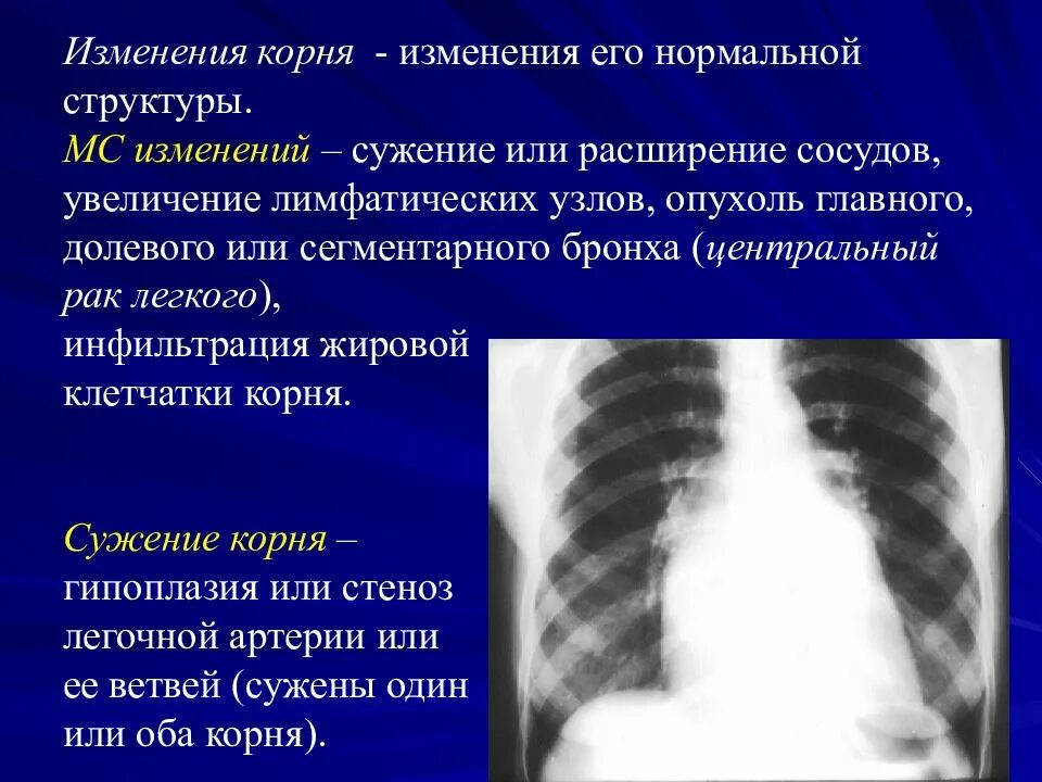 Изменение корня легкого. Причины изменения корня легкого. Корень легкого расширен. Изменения корня легкого