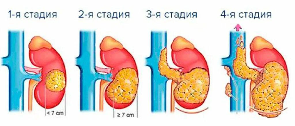 Рак желудка 4 лечение. Опухоль желудка 4 стадия.