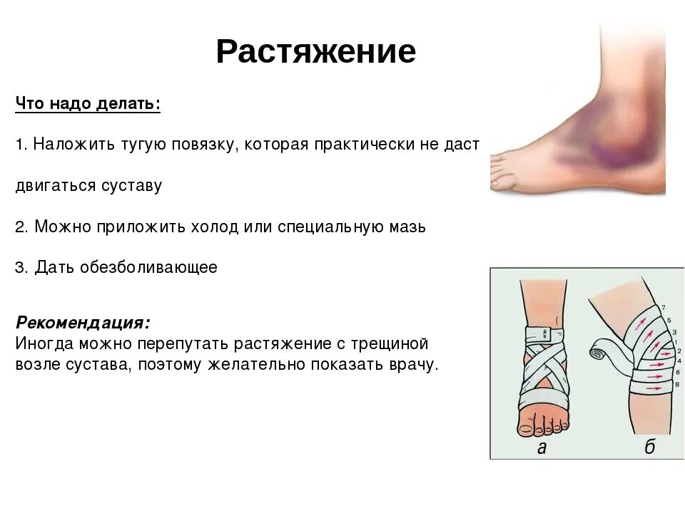 При растяжении сухожилия стопы. Что делать при растяжении мыш.