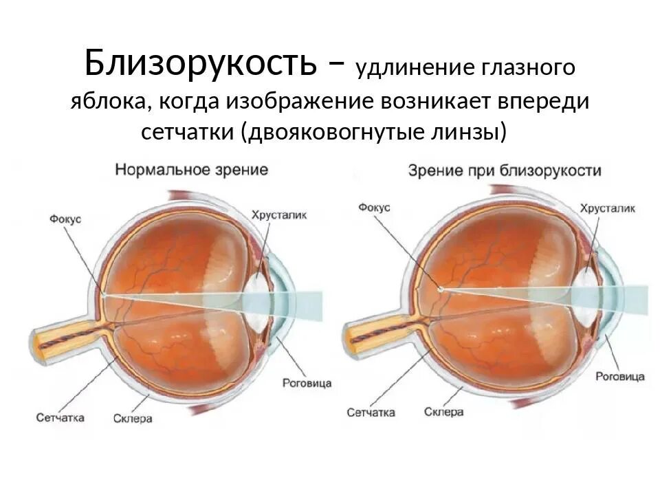 Миопия гиперметропия астигматизм. Гиперметропия 2 степени у детей 2 года. Строение глаза астигматизм. Дальнозоркость 8 диоптрий. Слабая миопия глаза что