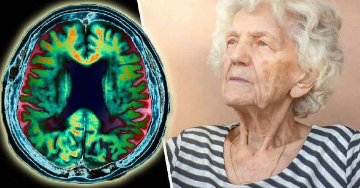 Болезнь Альцгеймера деменция. Деменция в старости. Болезнь Альцгеймера фото. Мозг в старости. Уилис деменция