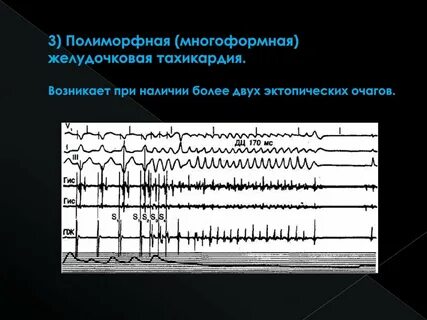 Полиморфная желудочковая