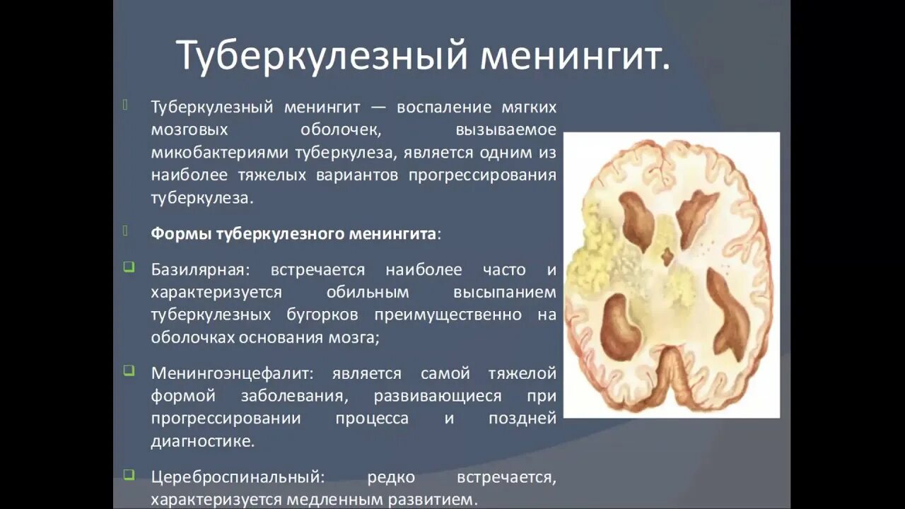 Туберкулез мозговых оболочек