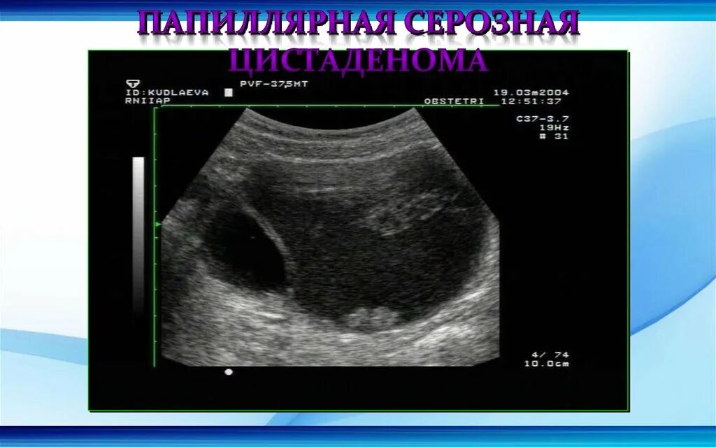 Серозная папиллярная грубососочковая цистаденофиброма яичника. Серозная киста яичника на УЗИ. Цистаденома яичника на УЗИ. Папиллярная серозная цистаденома яичника. Серозная пограничная опухоль