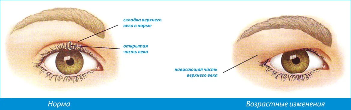 Как изменяются века. Складки на верхних веках. Нависающая складка верхнего века.