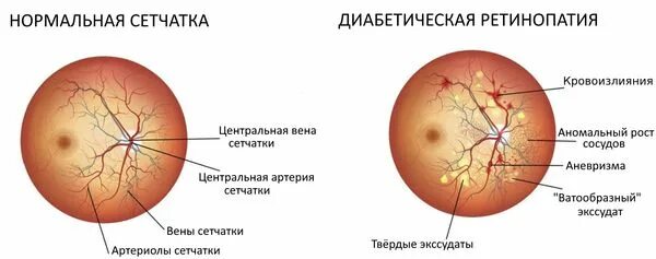 Диабетическая ретинопатия. Гипертоническая ангиопатия сосудов. Препараты при ангиопатии сетчатки глаза. Центральная серозная ретинопатия глаза.