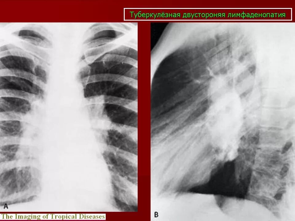 Лимфаденопатия внутригрудных лимфоузлов. Внутригрудная лимфаденопатия рентген. Туберкулез внутригрудных лимфатических узлов. Туберкулез лимфаденопатия. Аденопатия