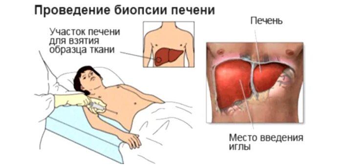 Как делается биопсия печени. Тонкоигольная биопсия печени. чрескожная биопсия печени. пункционная биопсия печени при циррозе. чрескожная пункционная биопсия печени.