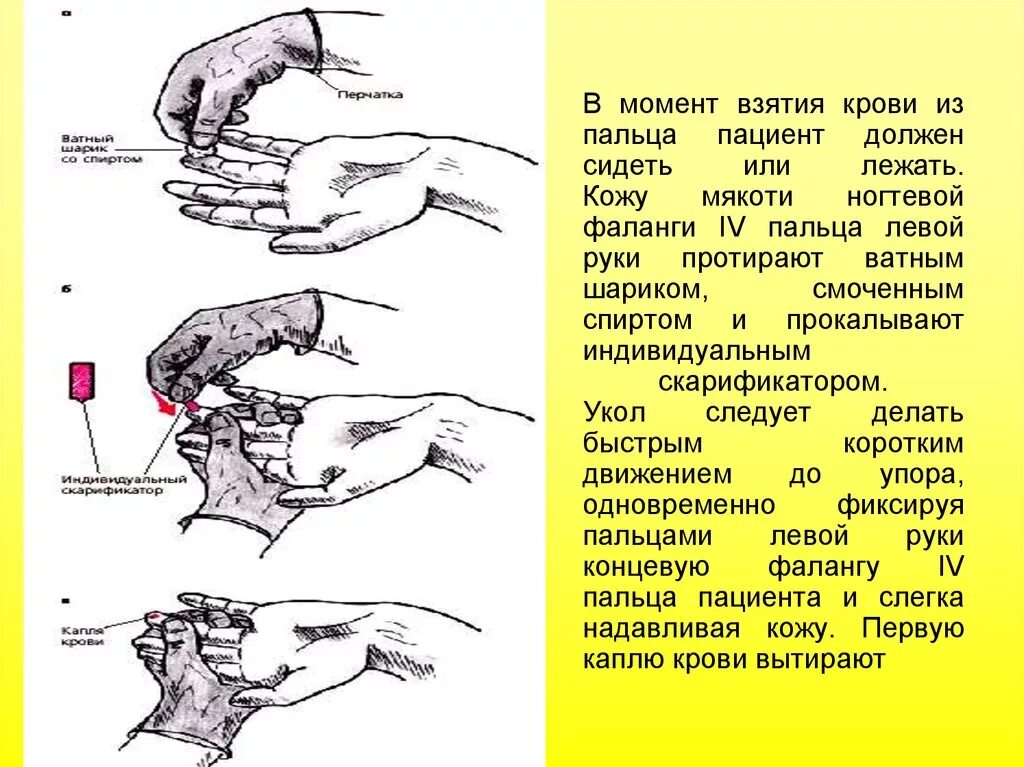 Алгоритм взятие. Взятие крови из пальца алгоритм. техника забора капиллярной крови из пальца. методика забора капиллярной крови. техника забора капиллярной крови у ребёнка.