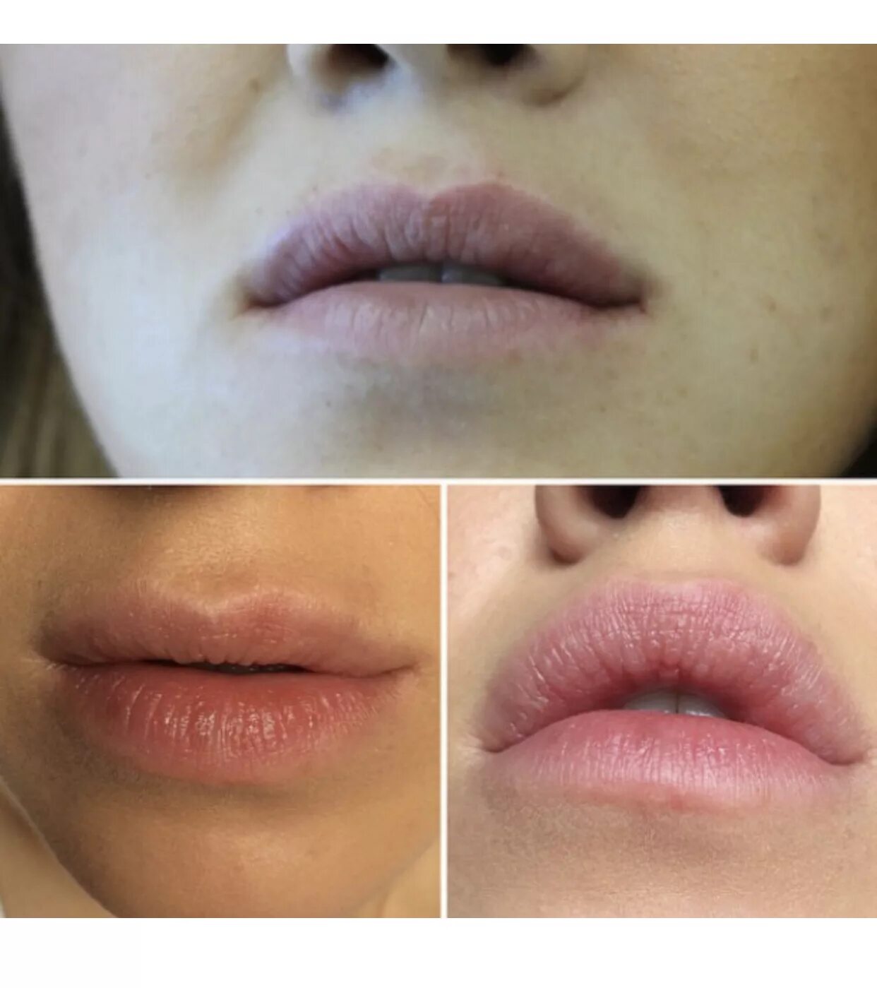 Сыворотка для увеличения губ. Гиалурон 1 мл в губы эффект. Губы после геля. Губы накаченные гиалуроновой. Губы после геля.