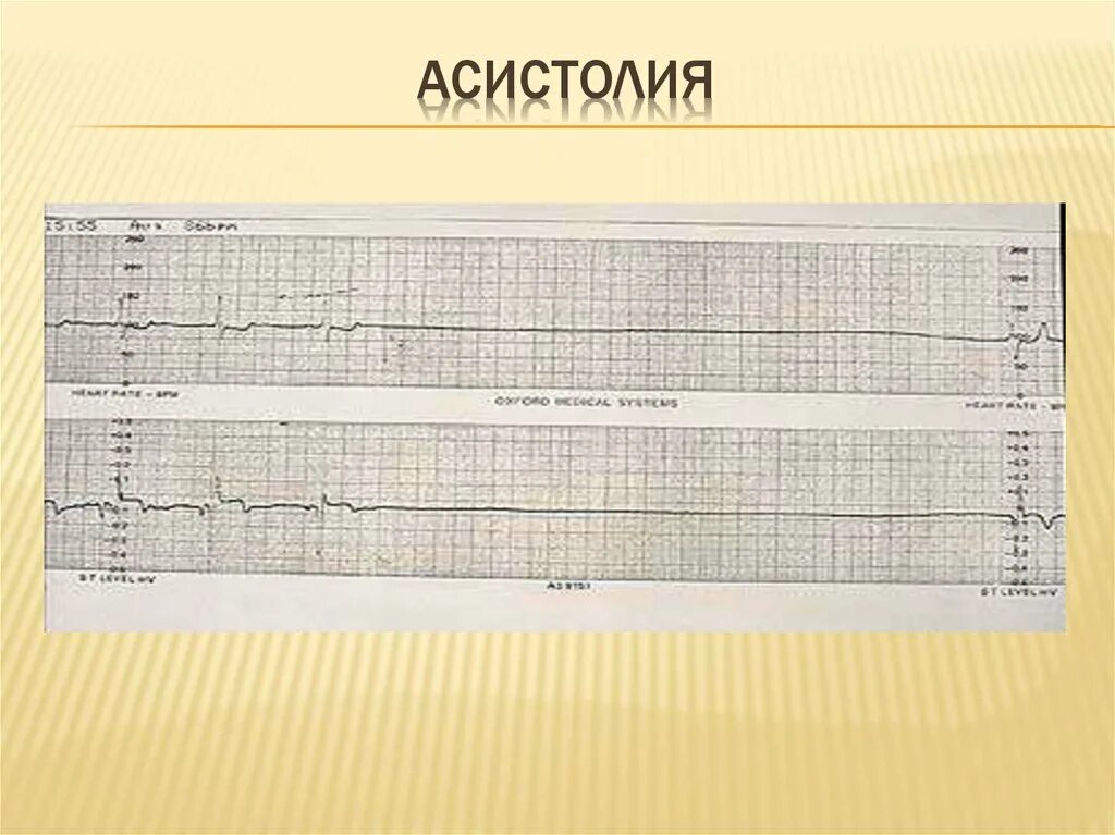 Асистолия это. Асистолия сердца на экг. Асистолия предсердий на экг. Асистолия. Асистолия это.