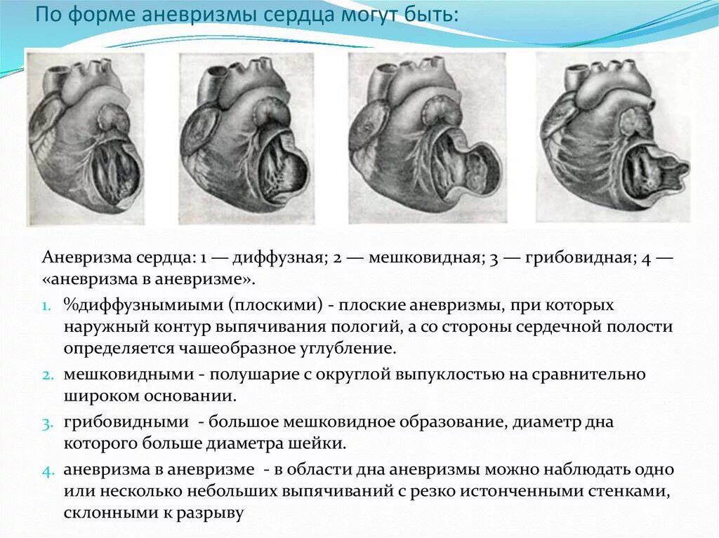 Мешковидная аневризма. Хроническая аневризма сердца. Аневризма сердца что это такое симптомы