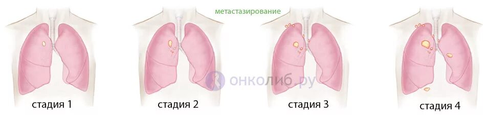 3 стадия рака с метастазами