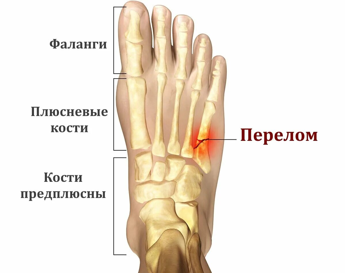 Трещина 5. 5 Плюсневая кость стопы. 5 Плюсневой кости стопы. Стрессовый перелом 5 плюсневой кости. Перелом 5 плюсневой кости стопы.