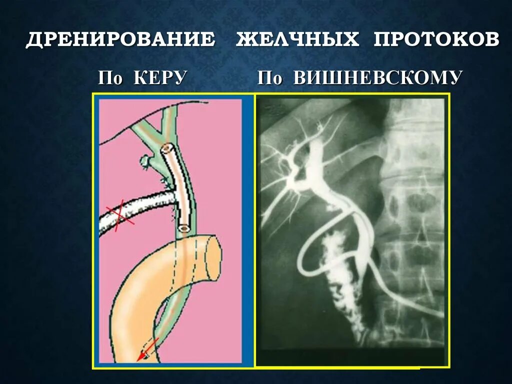 Дренаж холедоха желчного протока. Дренаж желчного пузырного протока. Наружное дренирование желчного протока по керу. Холедохотомия и дренирование общего желчного протока.