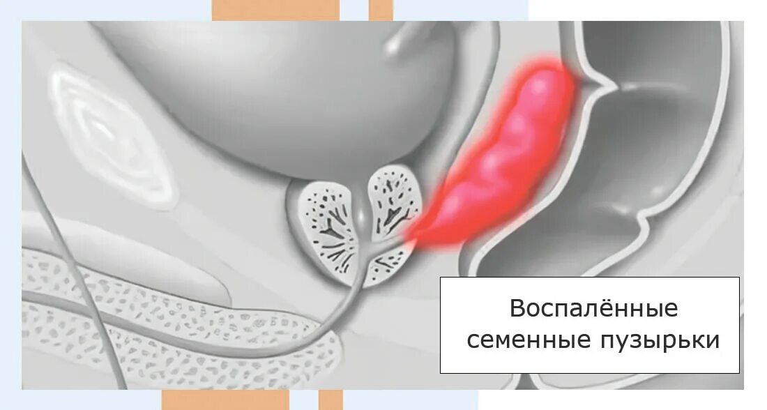 Воспаление семенного мужчин. Везикулит — воспаление семенных пузырьков. Везикулит у мужчин симптомы. Воспаление семенных пузырьков у мужчин симптомы. Гемоспермия семенные пузырьки.