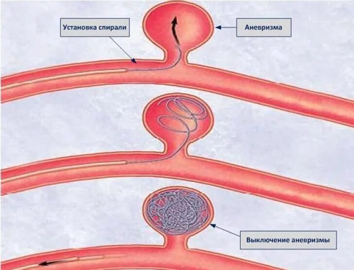 Эндоваскулярная операция аневризмы головного. Эндоваскулярная хирургия аневризм артерий головного мозга. Эндоваскулярные операции эмболизация. Эндоваскулярная операция сосудов головного мозга.
