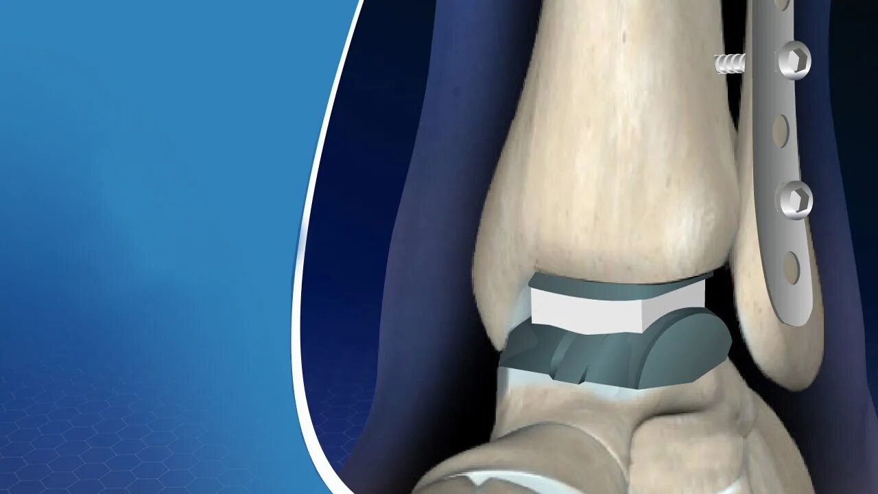Эндопротез голеностопного сустава. Эндопротезирование таранной кости. Эндопротез коленного сустава Maxx Orthopedics. Спейсер тазобедренного сустава.