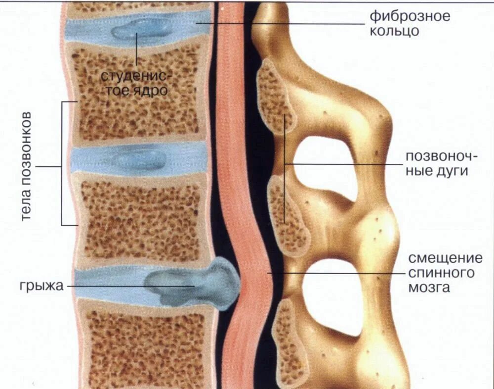 Спинные диски. Грыжа Шморля l4 позвонка. Междисковая грыжа позвоночника. Позвоночная грыжа l1-l2.
