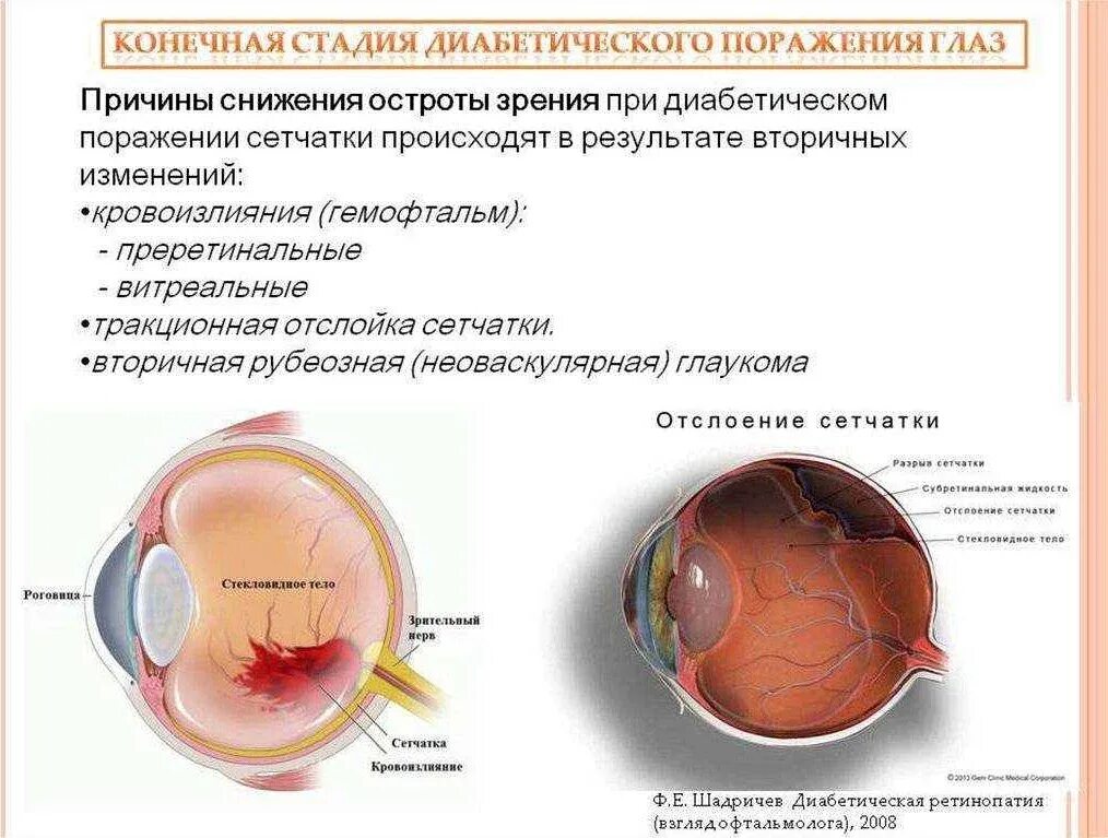 Катаракта глаза при сахарном диабете. Диабетическая ретинопатия биохимия. диабетическая ретинопатия нарушение зрения. диабетическая ретинопатия осложнения. нарушение зрения при сахарном диабете.