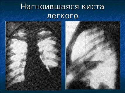 Киста легкого