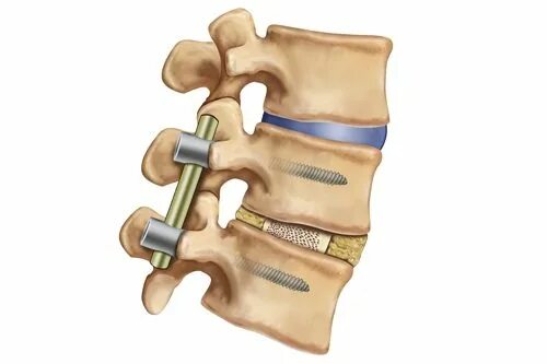 Задний спондилодез поясничного отдела позвоночника. Передний спондилодез шейного отдела. Пояснично крестцовый отдел операция на позвоночнике