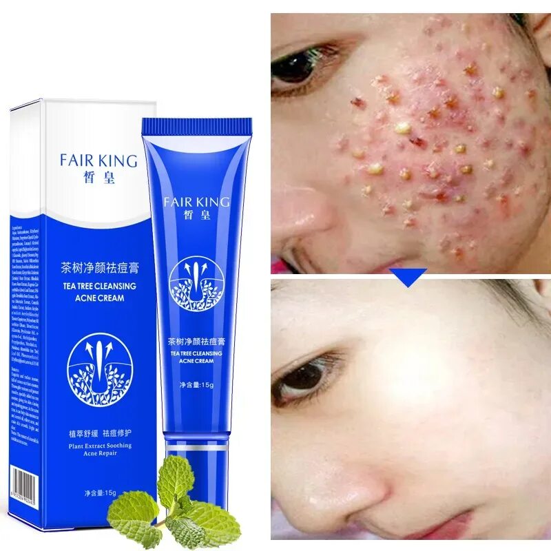 Как раз и навсегда избавиться от прыщей. Анти-акне крем anti-acne cream. средства от акне и прыщей.