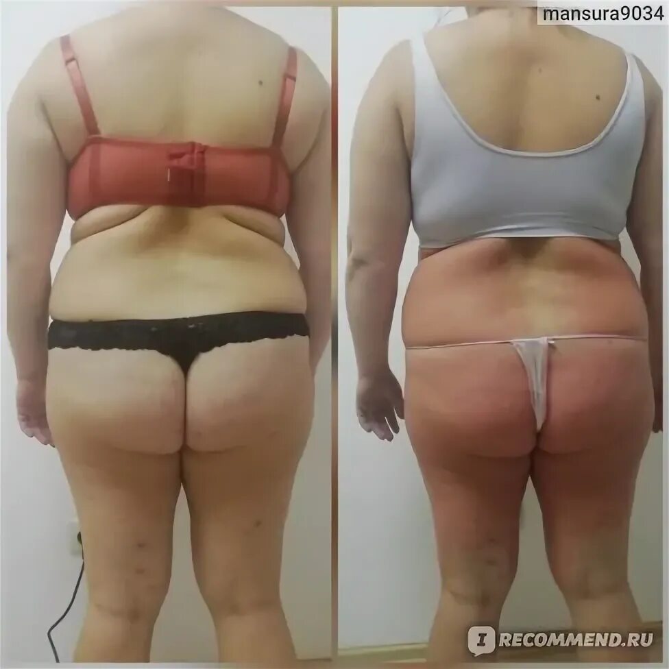 Лпд массаж до и после отзывы Anti-cellulite Massage + Wrap FREE