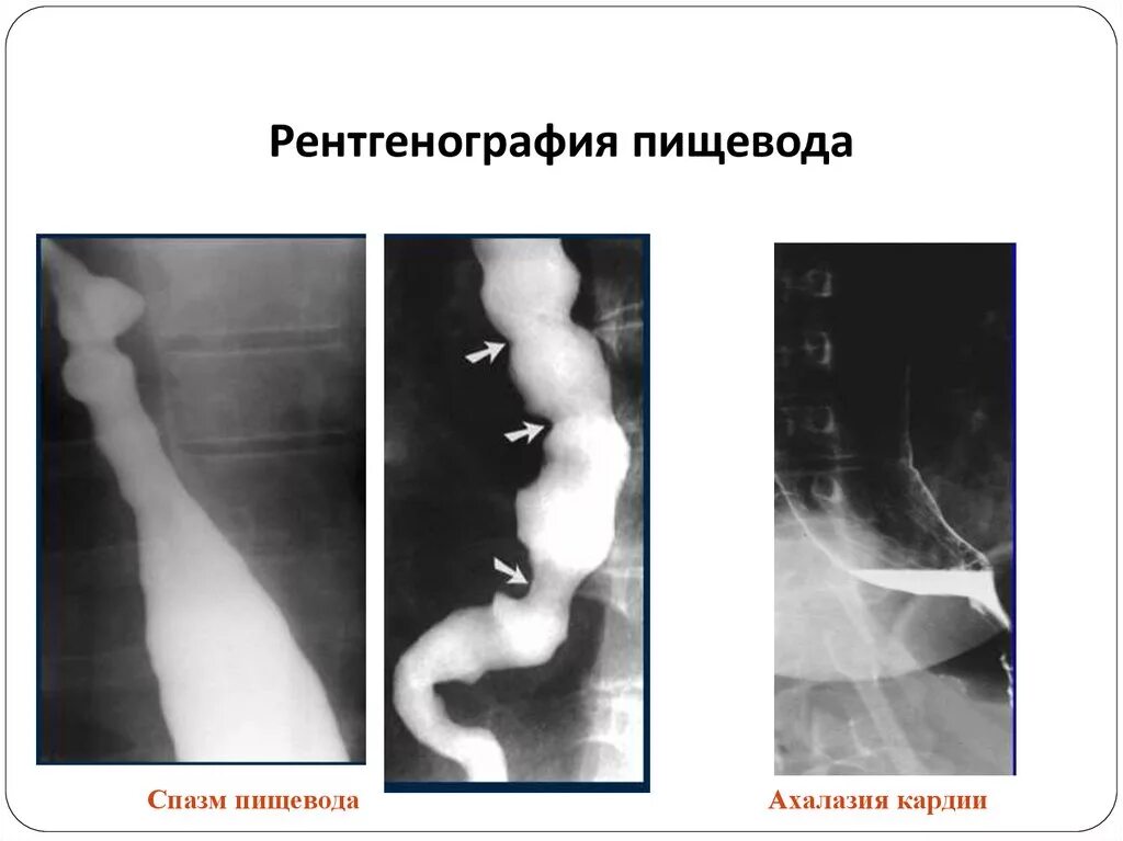 Скопия пищевода. Ахалазия пищевода рентген. Эзофагоспазм пищевода рентген. Ахалазия кардии рентген. Ахалазия кардии пищевода рентген.