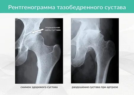 Чем отличается коксартроз от артроза тазобедренного сустава