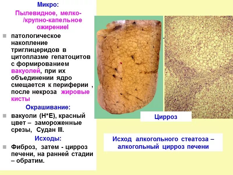 Микро изменение. Гидропической дистрофии печени. Гидропическая дистрофия почки макропрепарат. Стеатоз печени макропрепарат. Гидропическая дистрофия печени макропрепарат.