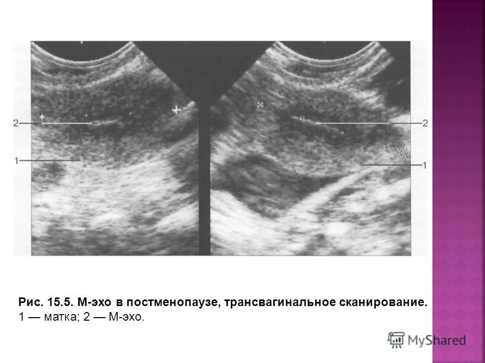 Толщина эндометрия в постменопаузе. Измерение толщины эндометрия на УЗИ. М Эхо 1,2 мм. М-Эхо 7.9 мм это. М-Эхо: 1.9 мм.