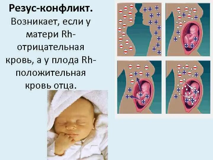 Родить с отрицательным резусом. Резус конфликт. Резус конфликт матери и ребенка. Дети рожденные с резус конфликтом.