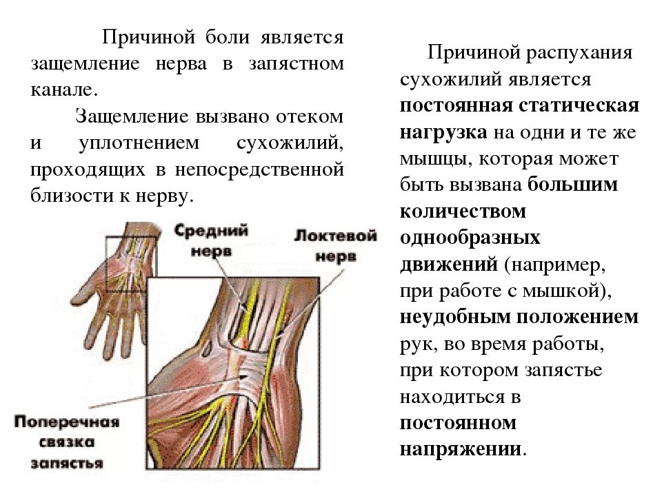 Защемление нервов в руке. Ишемия нерва