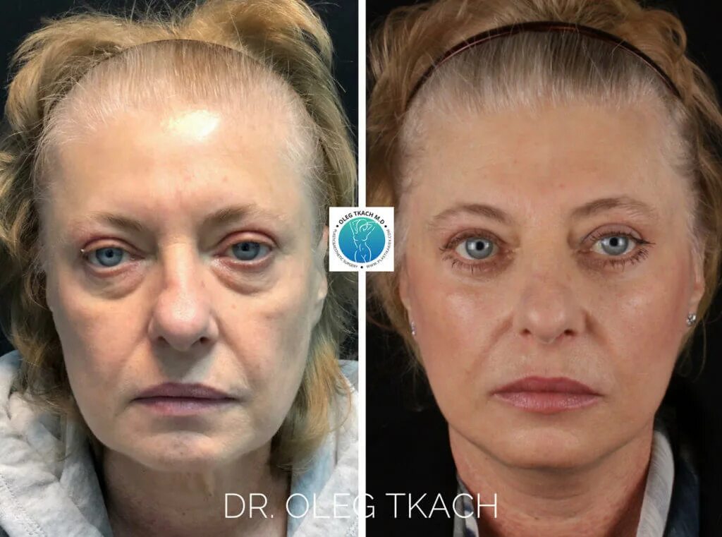 круговая подтяжка лица в 40 лет. круговая подтяжка лица в воронеже. круговая подтяжка лица в воронеже. круговая подтяжка лица до и после. смас в 25 лет.