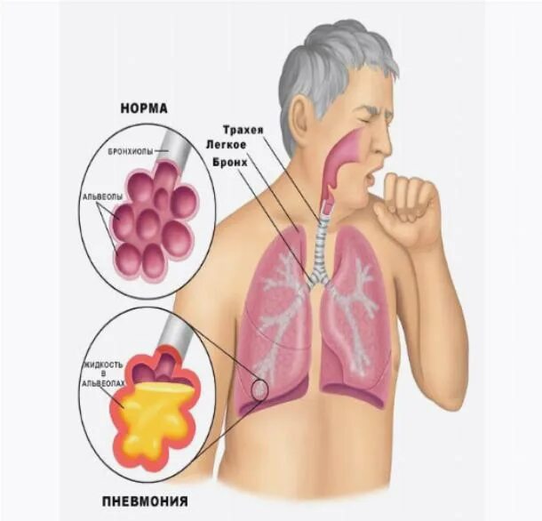 отек легких при пневмонии. казеозная пневмония диссеминированный туберкулез. жидкость в легких симптомы. рентгенодиагностика очаговой пневмонии.